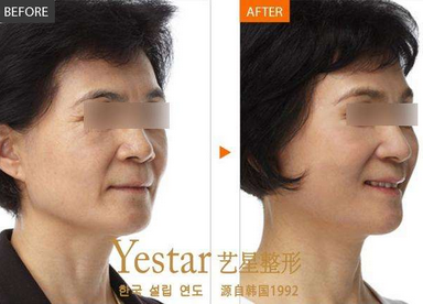 玻尿酸除皱
