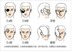 用激光祛太田痣会出现副作用吗