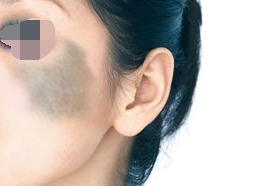 上海艺星激光祛太田痣效果好吗