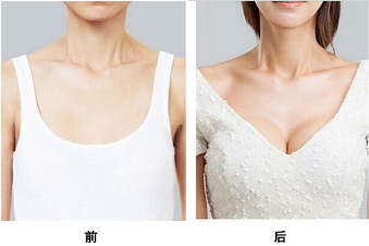 上海艺星假体隆胸效果对比图