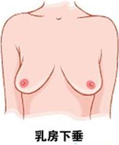 乳房下垂