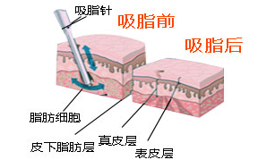 吸脂原理