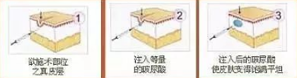 玻尿酸除皱原理
