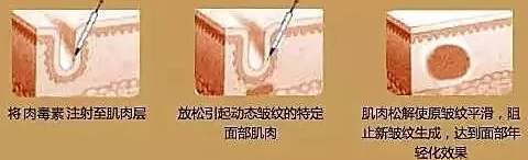 除皱原理