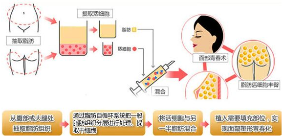 自体脂肪面部填充