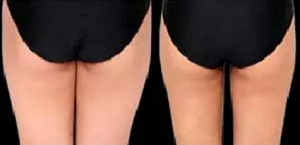 吸脂大腿内侧