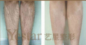 上海艺星激光脱腿毛效果对比图