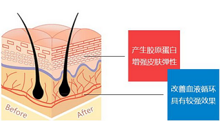 线雕提拉原理