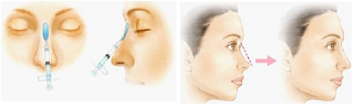 隆鼻方法