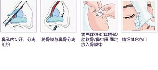 自体隆鼻手术图示