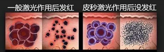 激光洗纹身原理