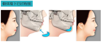 假体垫下巴过程