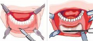 假体垫下巴口内切口方法