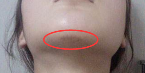 假体垫下巴术后护理注意事项