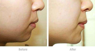 上海艺星假体垫下巴效果对比图