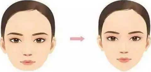 自体脂肪丰下巴