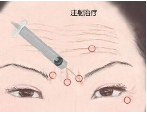 玻尿酸除皱
