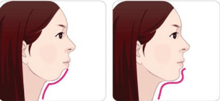 假体垫下巴后的护理