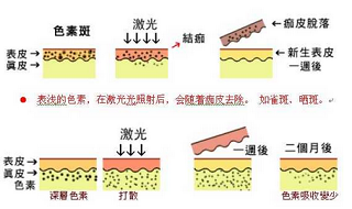 皮秒祛斑的原理