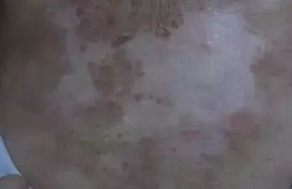 色素疤痕