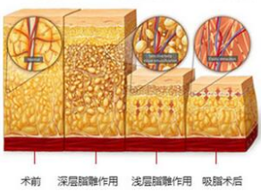 吸脂原理