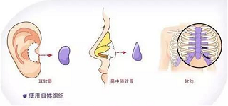 隆鼻使用的的自体软骨