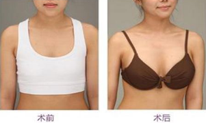 乳房下垂矫正蜕变对比图