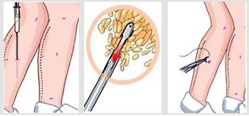 小腿吸脂手术图示