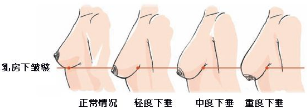 乳房下垂矫正程度