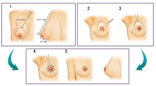 乳房下垂矫正