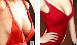 上海艺星乳房下垂矫正效果