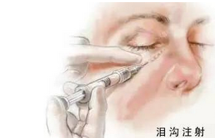 填充泪沟
