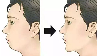 硅胶垫下巴的效果图