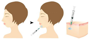 玻尿酸垫下巴图示
