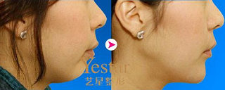 艺星垫下巴案例效果