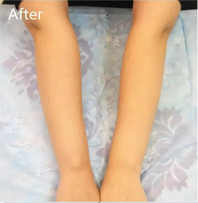 脱毛之后