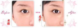 上海艺星开眼角手术前后对比