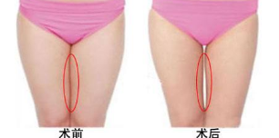 艺星大腿吸脂效果