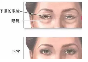 眼袋