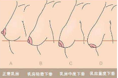 下垂的程度