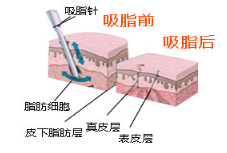 吸脂原理