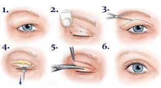 全切双眼皮手术
