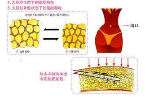 腰腹部吸脂