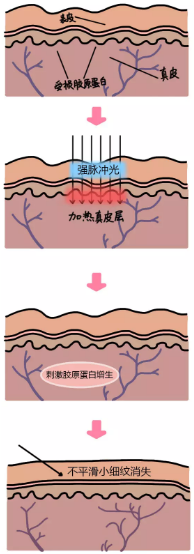 光子嫩肤原理