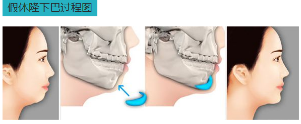 垫下巴过程