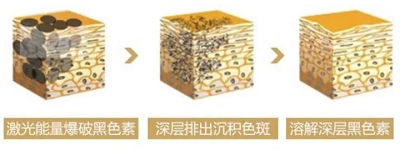 激光祛斑的过程