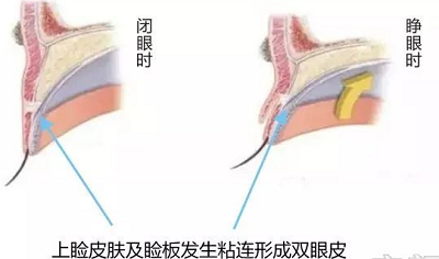 双眼皮肌肉原理