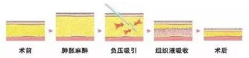 吸脂的整个过程