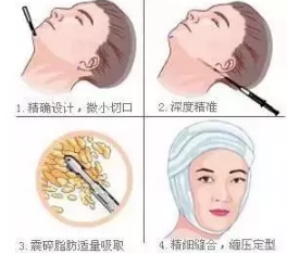 面部吸脂示意图