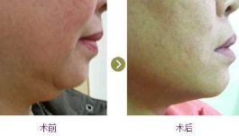 超声刀治疗衰老型双下巴效果
